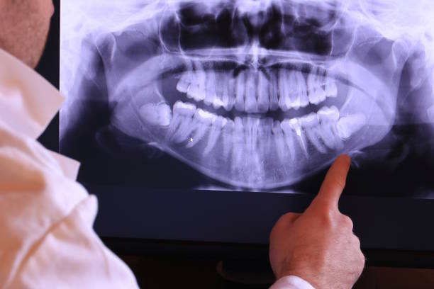 Best Emergency Dentist for Lost Fillings or Crowns in Jean Fitte, LA
